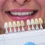 Why Veneers Are a Popular Choice for Smile Makeovers in London
