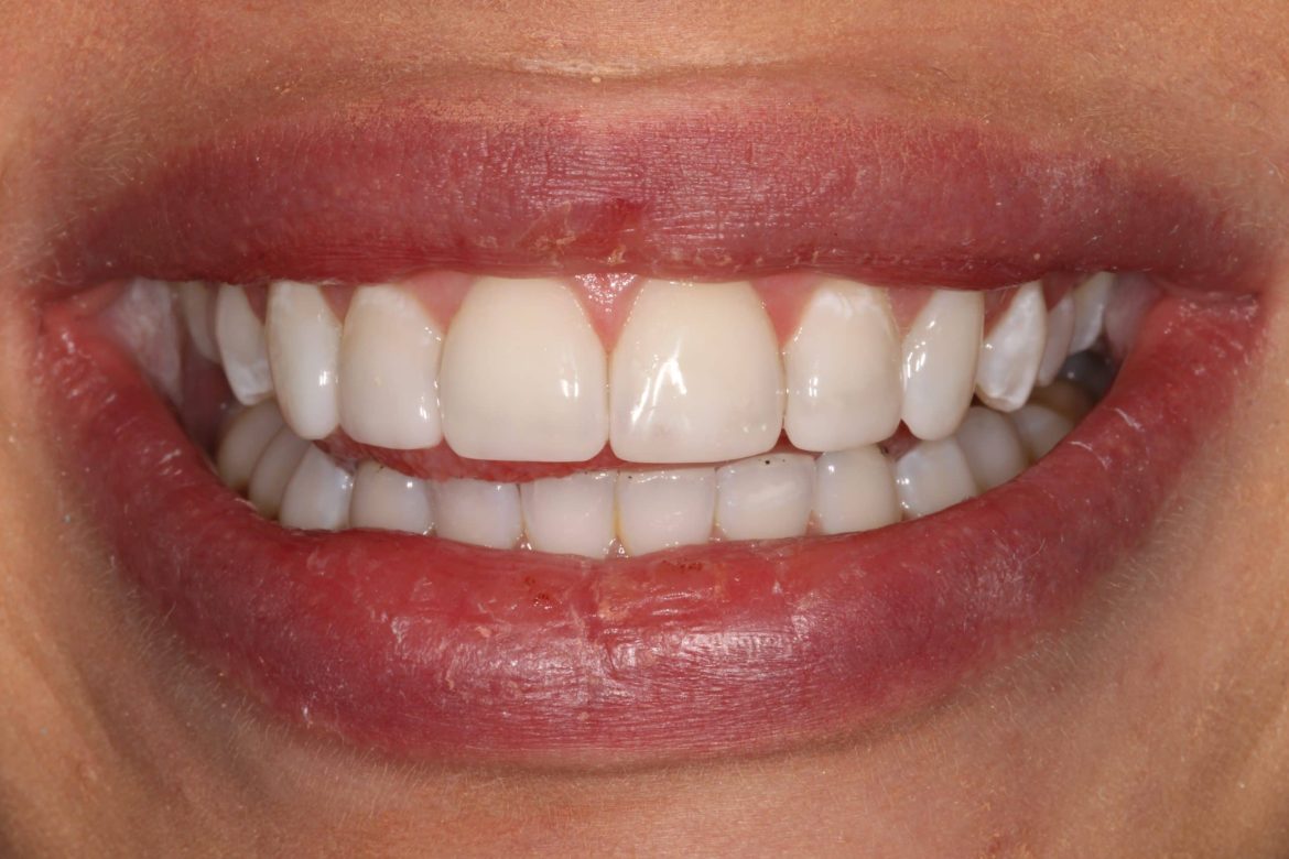 Understanding the Longevity of Composite Bonding Treatments