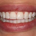 Understanding the Longevity of Composite Bonding Treatments