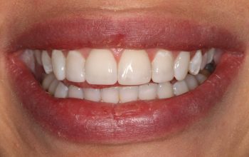 Understanding the Longevity of Composite Bonding Treatments
