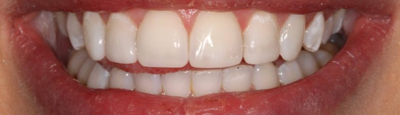 Understanding the Longevity of Composite Bonding Treatments