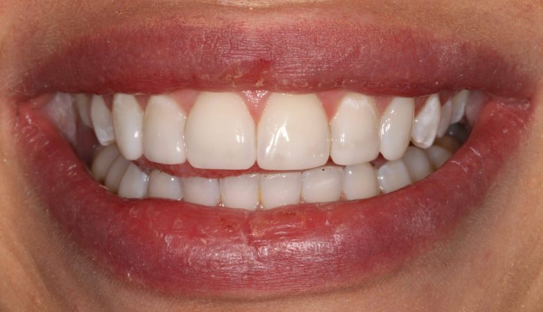 Understanding the Longevity of Composite Bonding Treatments