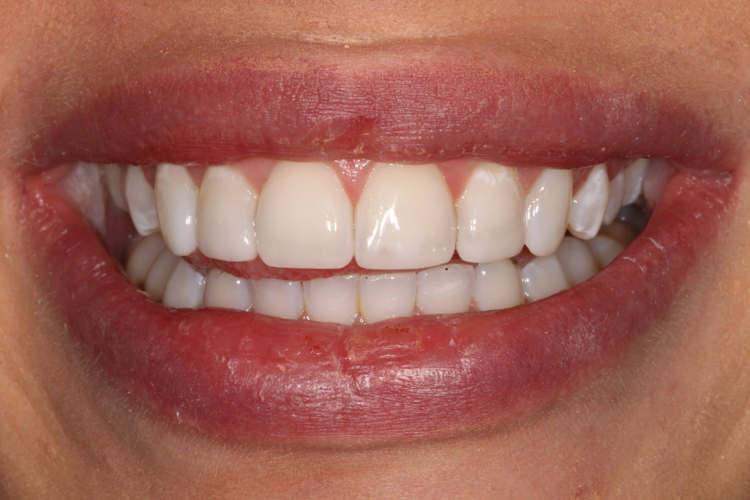 Understanding the Longevity of Composite Bonding Treatments